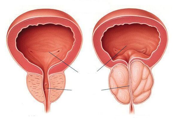 Prostatita ajută la erecție, Formă acută